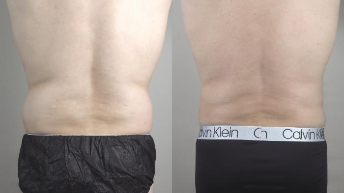 Liposuction Case 1222 Before & After View #3 | Paramus, NJ | Parker Center for Plastic Surgery