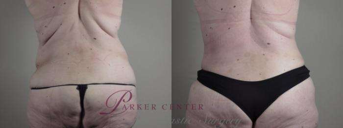 Body Case 1286 Before & After back  | Paramus, NJ | Parker Center for Plastic Surgery