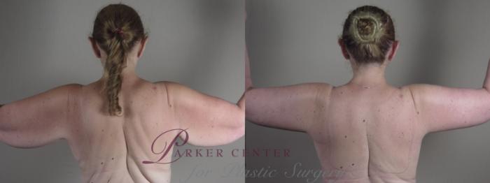 Body Case 1286 Before & After Back | Paramus, NJ | Parker Center for Plastic Surgery