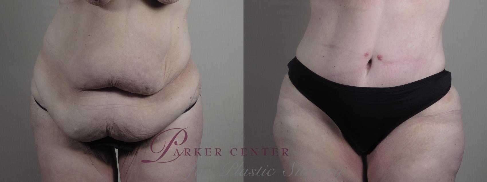 Body Case 1286 Before & After front  | Paramus, NJ | Parker Center for Plastic Surgery