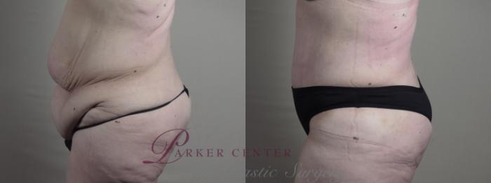 Body Case 1286 Before & After Left Side | Paramus, NJ | Parker Center for Plastic Surgery