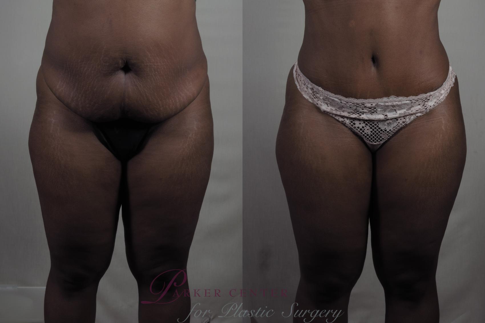 Liposuction Case 1327 Before & After Front | Paramus, NJ | Parker Center for Plastic Surgery