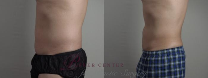 Liposuction Case 1337 Before & After Left Side | Paramus, NJ | Parker Center for Plastic Surgery