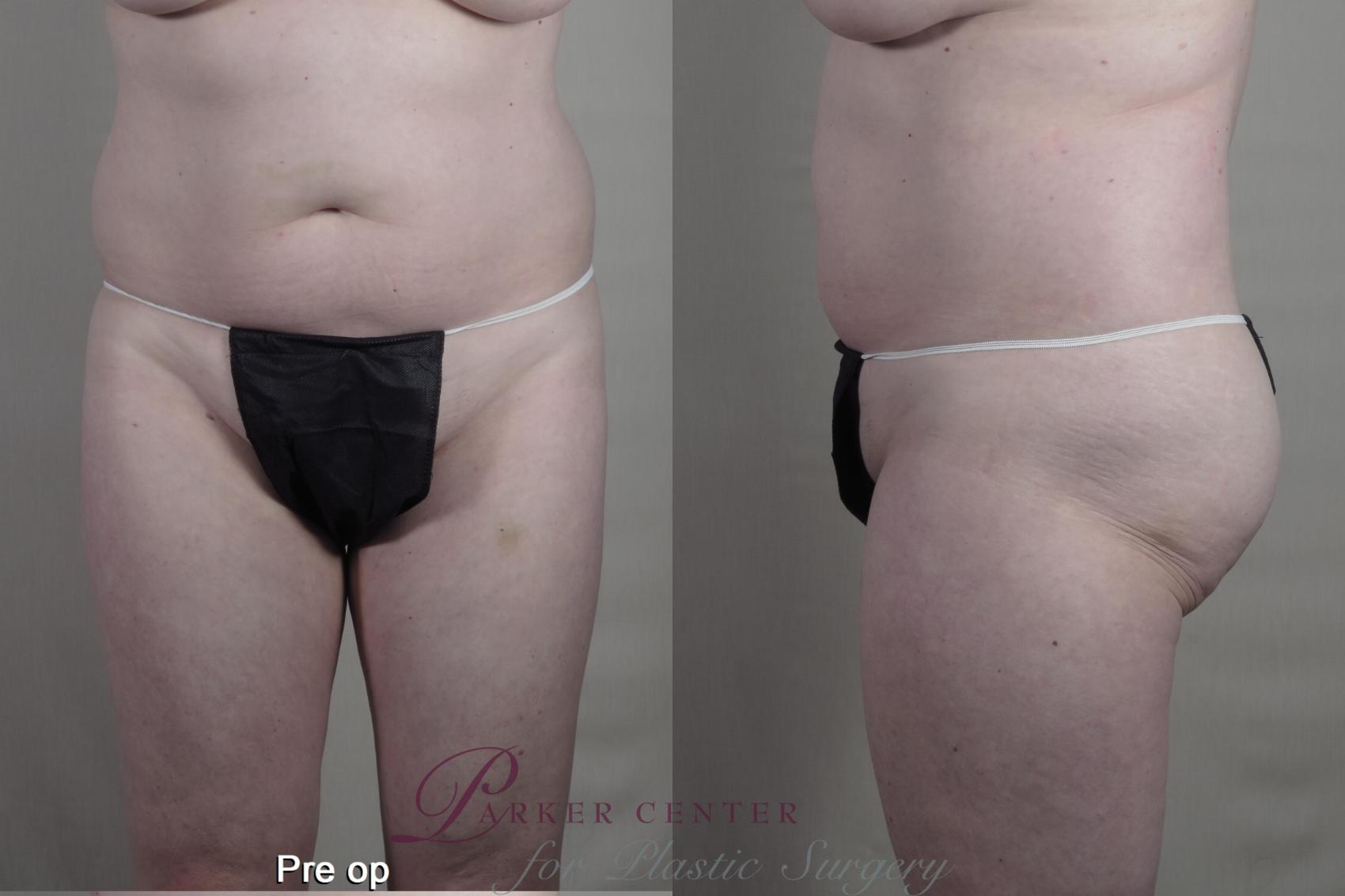 Liposuction Case 1364 Before & After pre op  | Paramus, New Jersey | Parker Center for Plastic Surgery