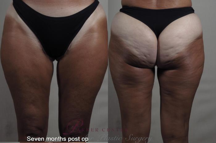 Liposuction Case 1365 Before & After months  | Paramus, New Jersey | Parker Center for Plastic Surgery