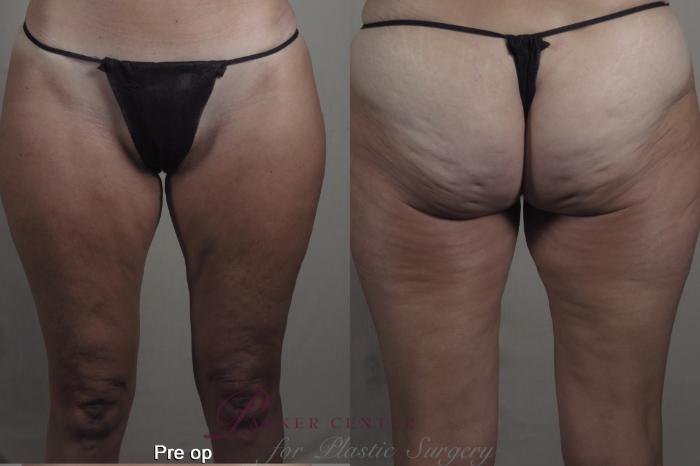 Liposuction Case 1365 Before & After pre op  | Paramus, New Jersey | Parker Center for Plastic Surgery