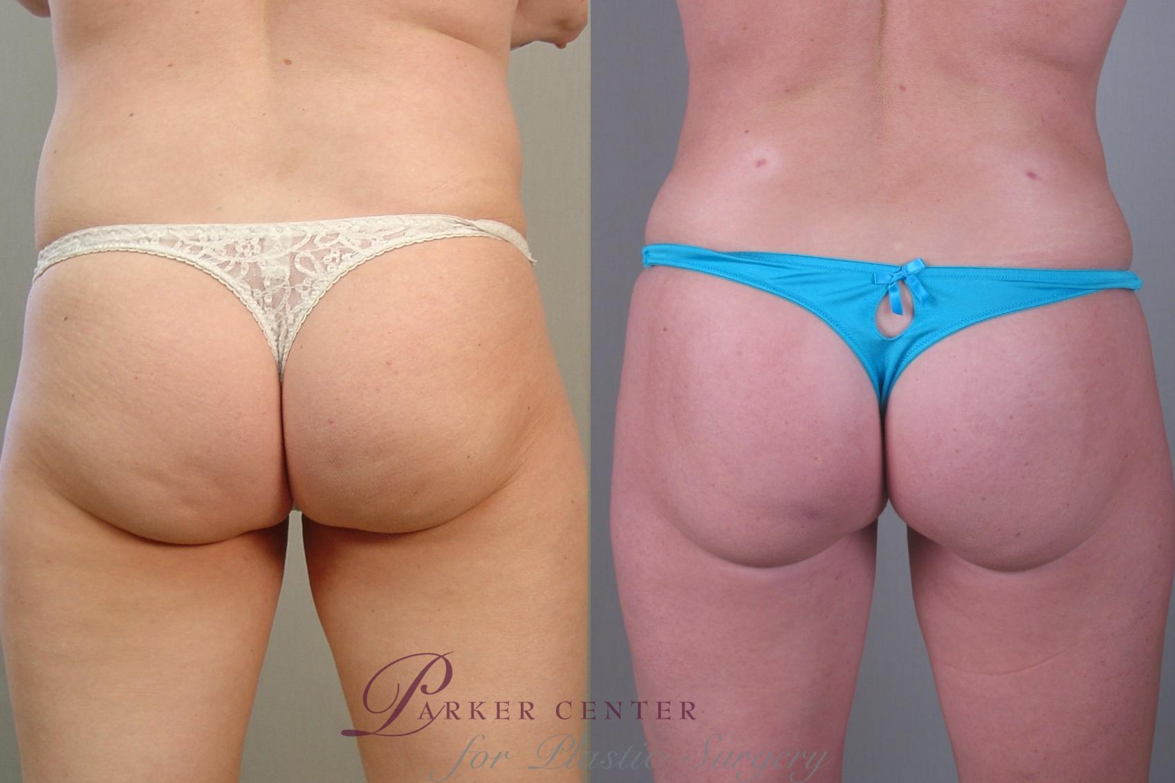 Liposuction Case 1372 Before & After Back | Paramus, New Jersey | Parker Center for Plastic Surgery