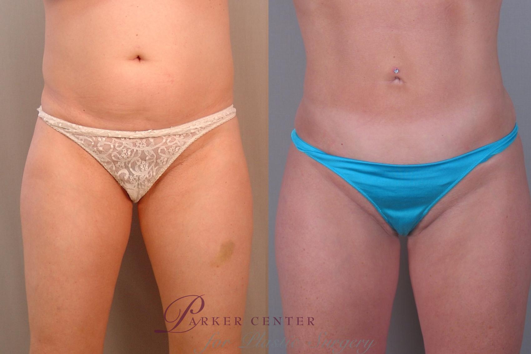 Liposuction Case 1372 Before & After Front | Paramus, NJ | Parker Center for Plastic Surgery