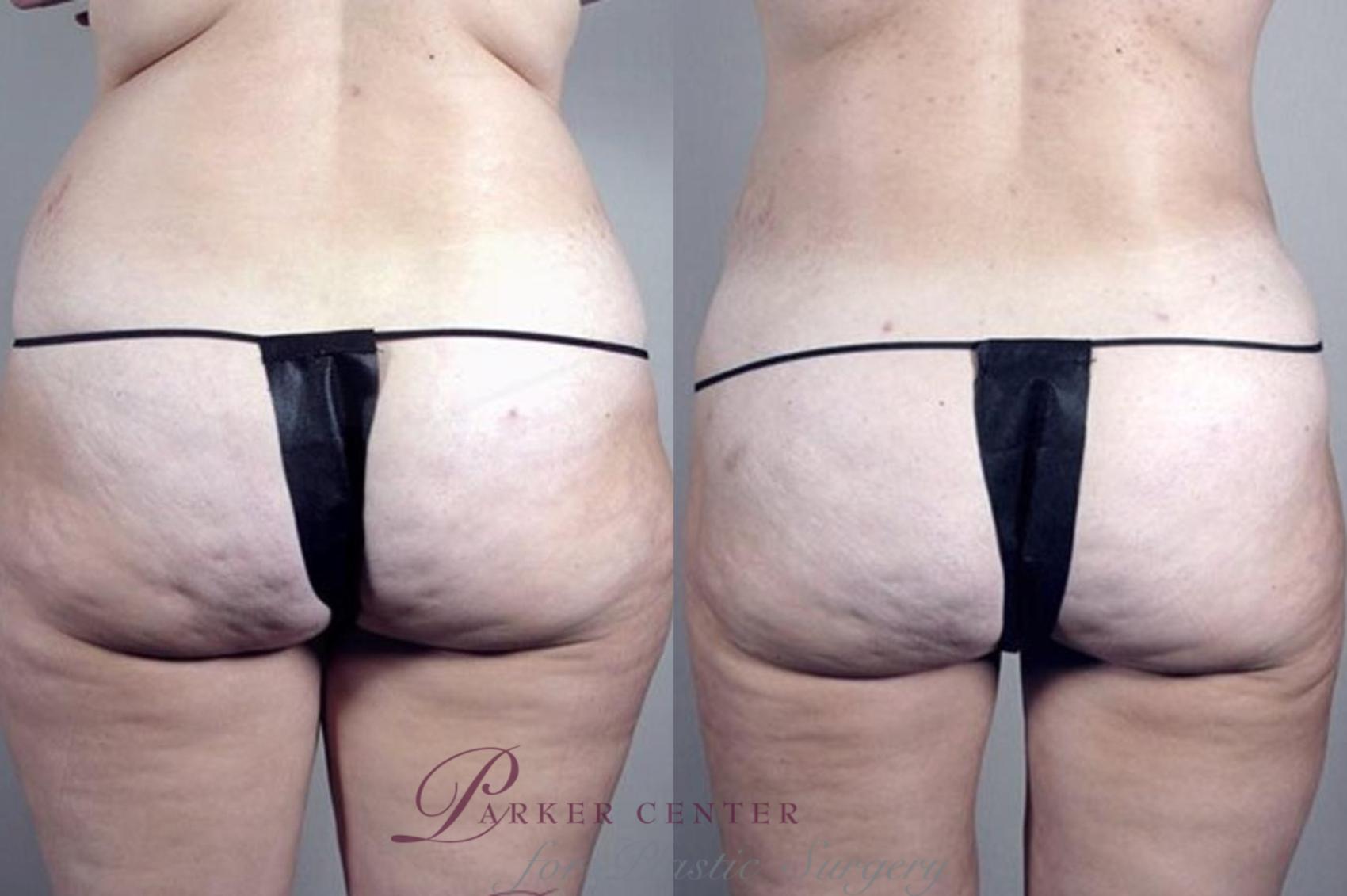 Liposuction Case 1382 Before & After Back | Paramus, New Jersey | Parker Center for Plastic Surgery