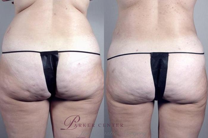 Liposuction Case 1382 Before & After Back | Paramus, NJ | Parker Center for Plastic Surgery