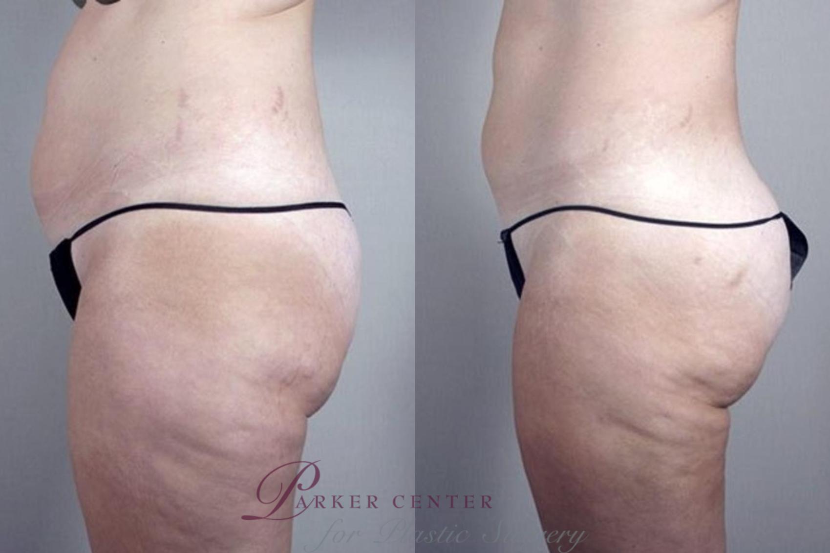 Liposuction Case 1382 Before & After Left Side | Paramus, New Jersey | Parker Center for Plastic Surgery