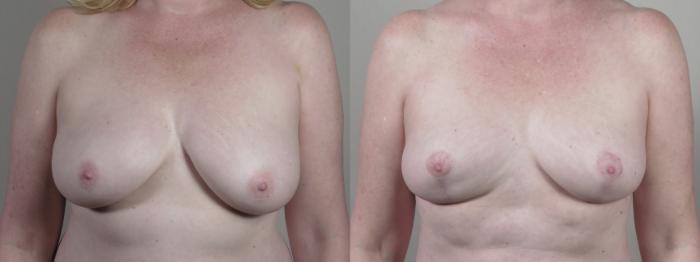 Liposuction Case 1428 Before & After breast reduction | Paramus, New Jersey | Parker Center for Plastic Surgery