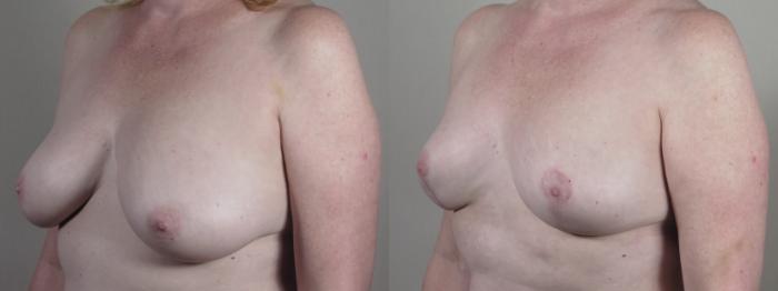 Liposuction Case 1428 Before & After Left Oblique | Paramus, New Jersey | Parker Center for Plastic Surgery