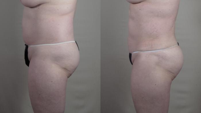 Liposuction Case 1428 Before & After side view | Paramus, New Jersey | Parker Center for Plastic Surgery