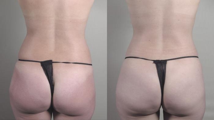 Liposuction Case 1459 Before & After Back | Paramus, New Jersey | Parker Center for Plastic Surgery