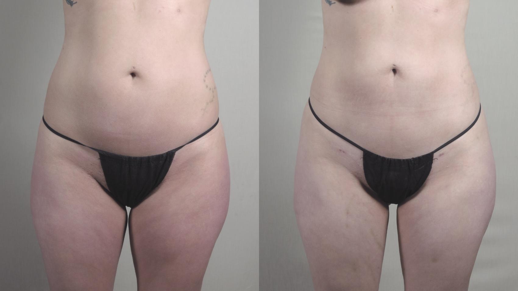 Liposuction Case 1459 Before & After Front | Paramus, New Jersey | Parker Center for Plastic Surgery