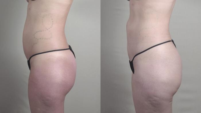 Liposuction Case 1459 Before & After Left Oblique | Paramus, New Jersey | Parker Center for Plastic Surgery