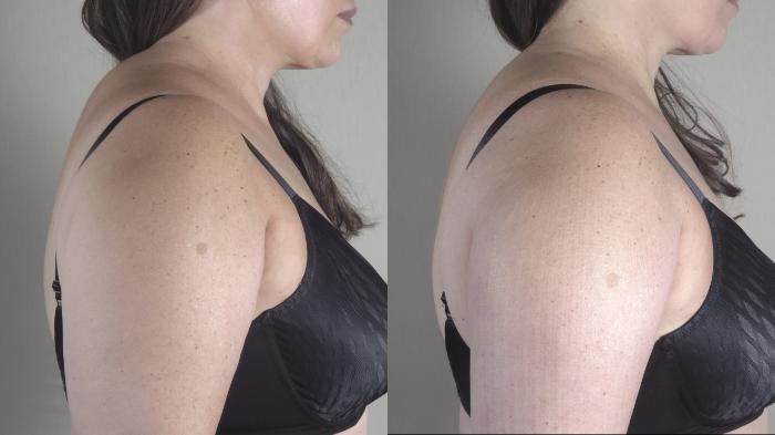 Liposuction Case 1465 Before & After Front | Paramus, New Jersey | Parker Center for Plastic Surgery