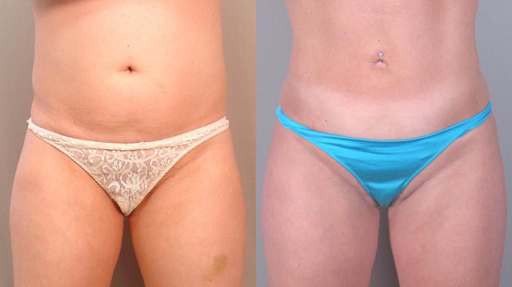 Liposuction Case 1479 Before & After Front | Paramus, New Jersey | Parker Center for Plastic Surgery