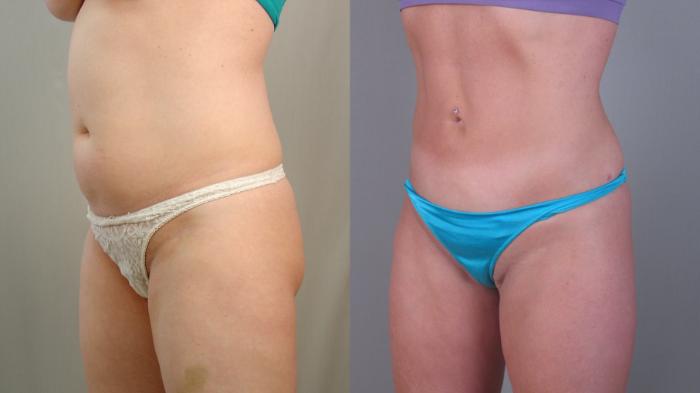 Liposuction Case 1479 Before & After Left Oblique | Paramus, New Jersey | Parker Center for Plastic Surgery