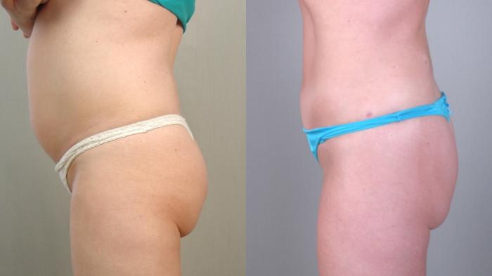 Liposuction Case 1479 Before & After Left Side | Paramus, New Jersey | Parker Center for Plastic Surgery