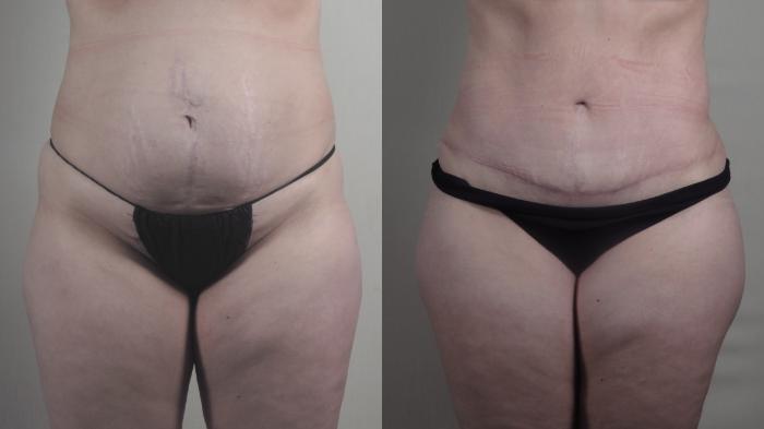 Liposuction Case 1516 Before & After Front | Paramus, New Jersey | Parker Center for Plastic Surgery