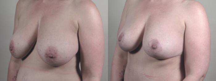 Liposuction Case 1516 Before & After Left Oblique | Paramus, New Jersey | Parker Center for Plastic Surgery