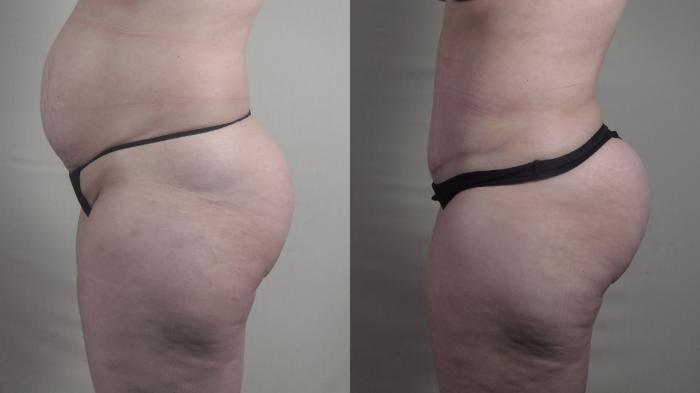 Liposuction Case 1516 Before & After Left Side | Paramus, New Jersey | Parker Center for Plastic Surgery