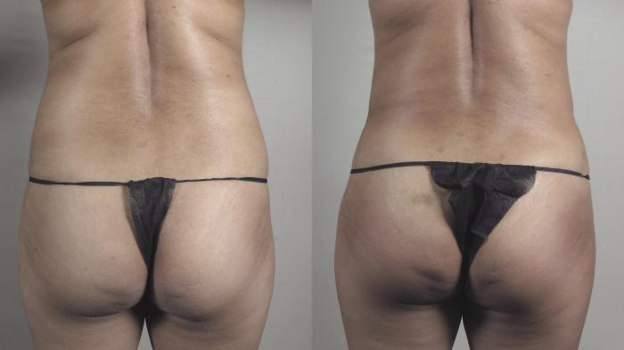 Liposuction Case 1517 Before & After Back | Paramus, New Jersey | Parker Center for Plastic Surgery