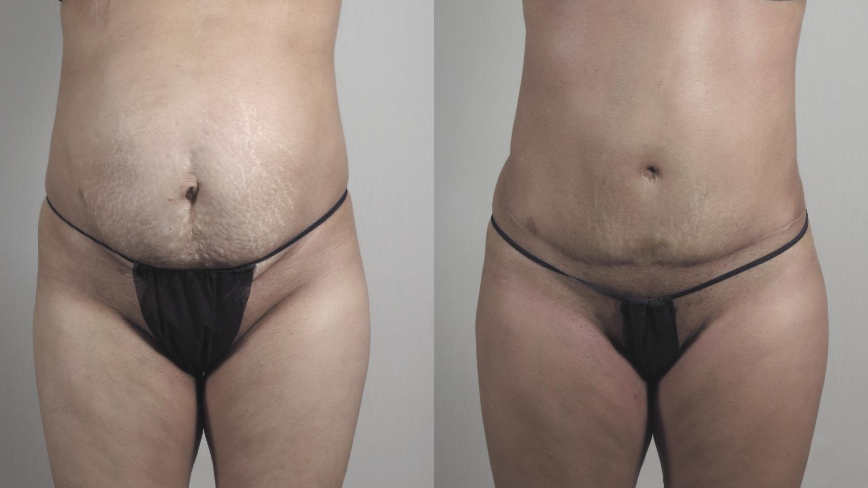 Liposuction Case 1517 Before & After Front | Paramus, New Jersey | Parker Center for Plastic Surgery