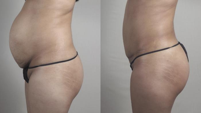 Liposuction Case 1517 Before & After Left Side | Paramus, New Jersey | Parker Center for Plastic Surgery