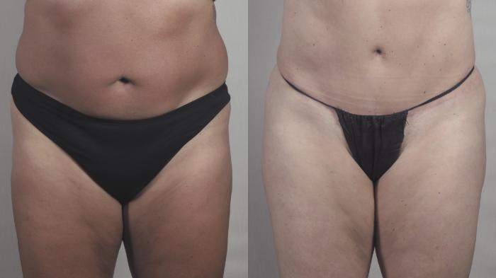 Liposuction Case 1518 Before & After Front | Paramus, New Jersey | Parker Center for Plastic Surgery