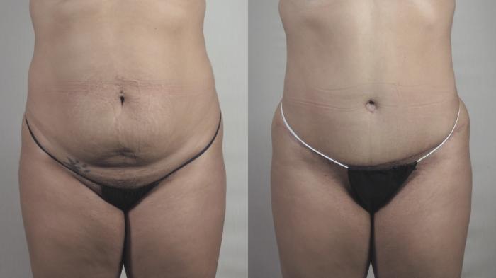 Liposuction Case 1519 Before & After Front | Paramus, New Jersey | Parker Center for Plastic Surgery