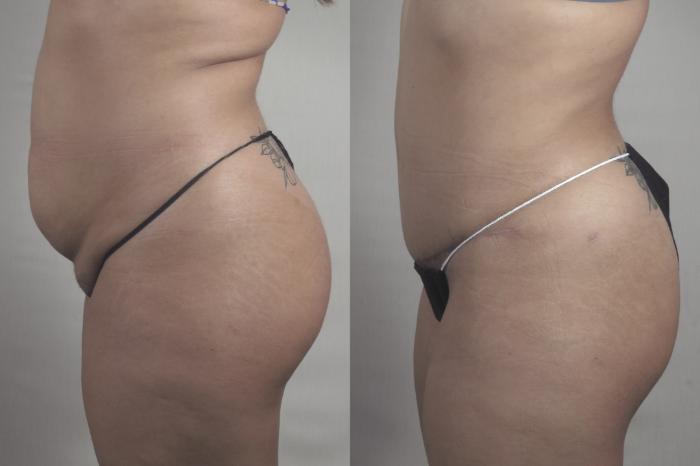 Liposuction Case 1519 Before & After Left Side | Paramus, New Jersey | Parker Center for Plastic Surgery