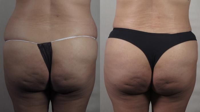 Liposuction Case 1523 Before & After Back | Paramus, New Jersey | Parker Center for Plastic Surgery