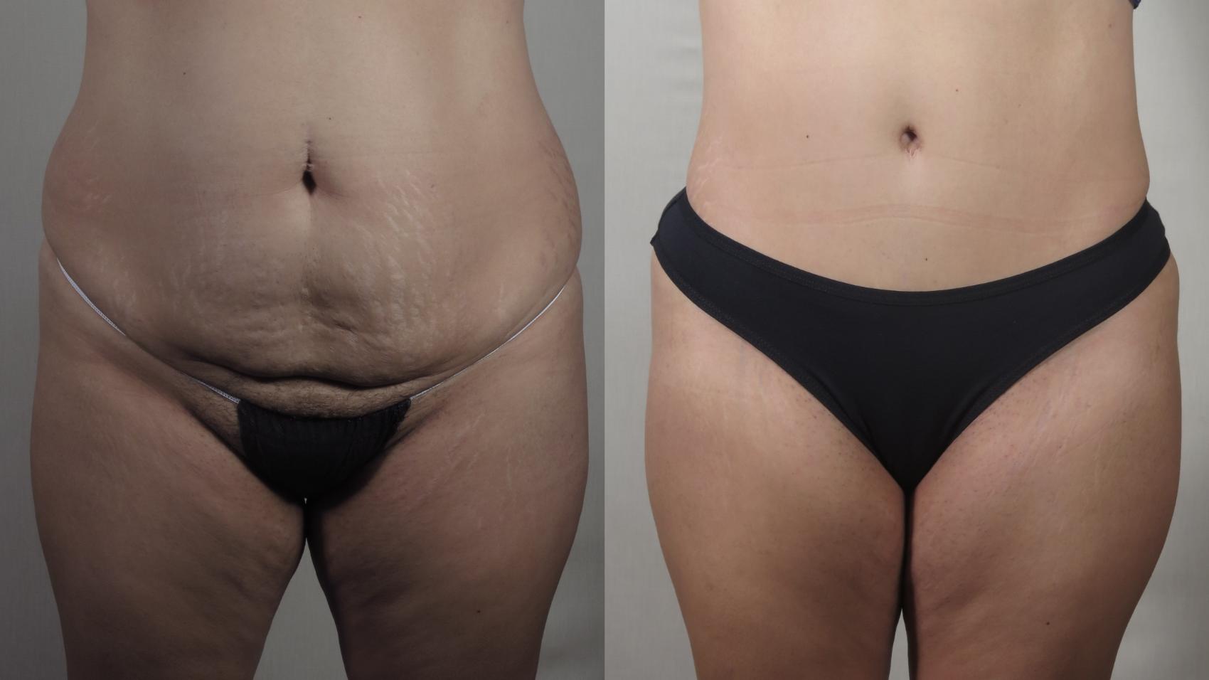 Liposuction Case 1523 Before & After Front | Paramus, New Jersey | Parker Center for Plastic Surgery