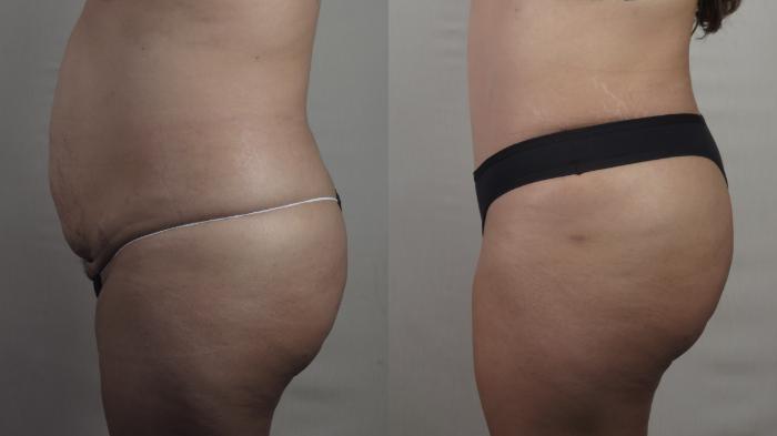 Liposuction Case 1523 Before & After Left Side | Paramus, New Jersey | Parker Center for Plastic Surgery