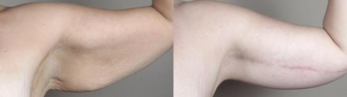 Liposuction Case 1524 Before & After arm 2 | Paramus, New Jersey | Parker Center for Plastic Surgery