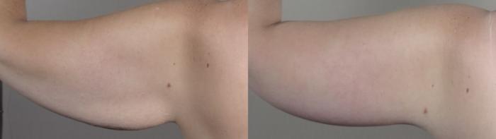 Liposuction Case 1524 Before & After back arm 2 | Paramus, New Jersey | Parker Center for Plastic Surgery