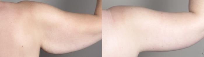 Liposuction Case 1524 Before & After back arm | Paramus, New Jersey | Parker Center for Plastic Surgery