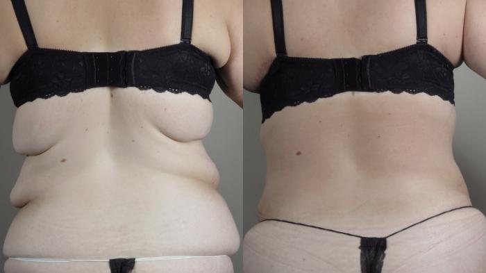 Liposuction Case 1524 Before & After bra line  | Paramus, New Jersey | Parker Center for Plastic Surgery