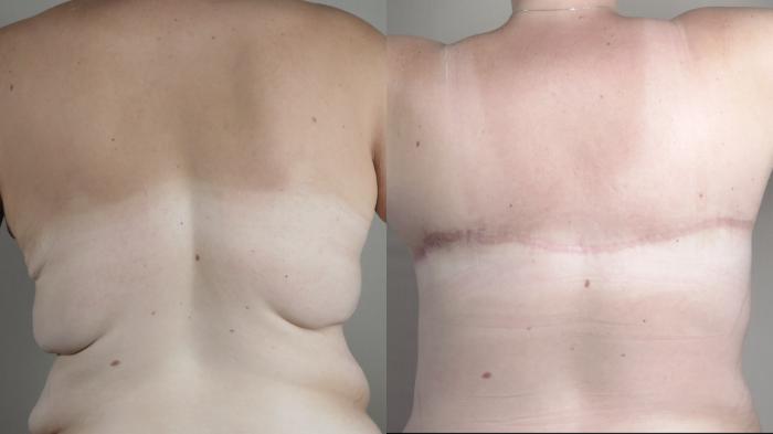 Liposuction Case 1524 Before & After bra line 2 | Paramus, New Jersey | Parker Center for Plastic Surgery