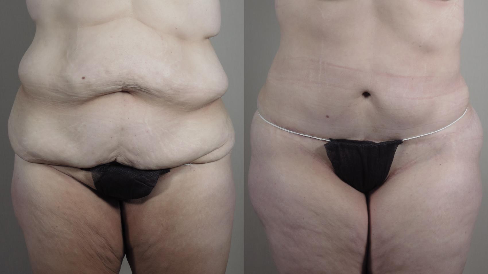 Liposuction Case 1524 Before & After Front | Paramus, New Jersey | Parker Center for Plastic Surgery