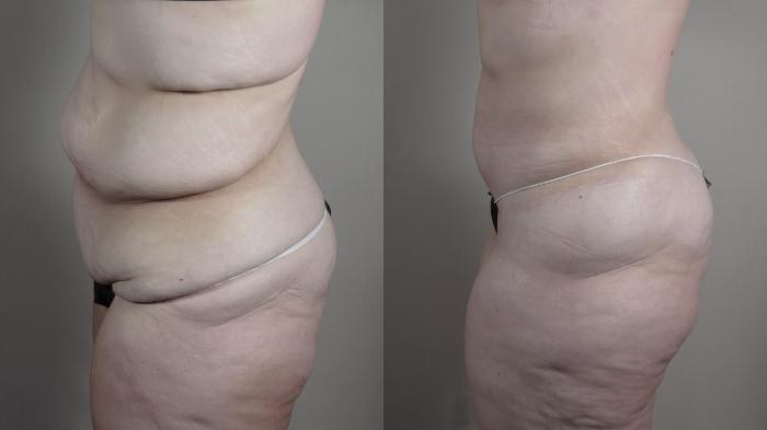 Liposuction Case 1524 Before & After Left Side | Paramus, New Jersey | Parker Center for Plastic Surgery