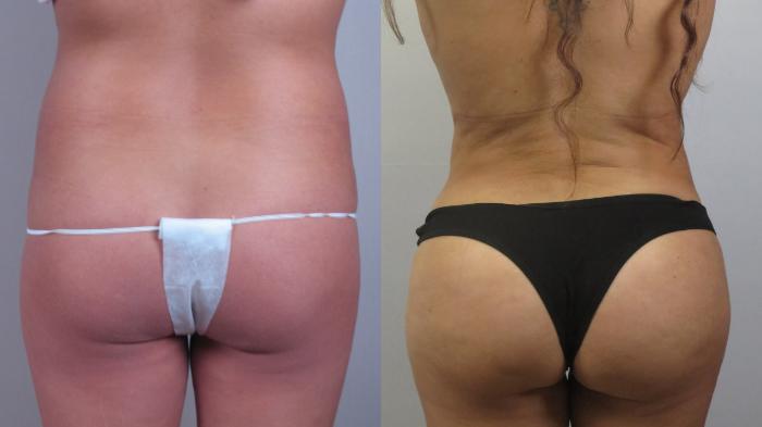 Liposuction Case 1602 Before & After Back | Paramus, New Jersey | Parker Center for Plastic Surgery
