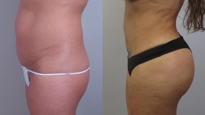 Liposuction Case 1602 Before & After Left Side | Paramus, New Jersey | Parker Center for Plastic Surgery