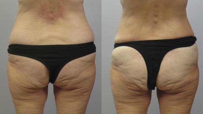 Liposuction Case 1621 Before & After Back | Paramus, New Jersey | Parker Center for Plastic Surgery