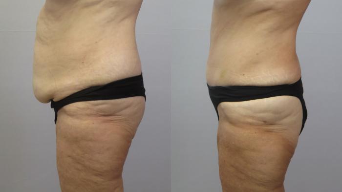 Liposuction Case 1621 Before & After Left Side | Paramus, New Jersey | Parker Center for Plastic Surgery
