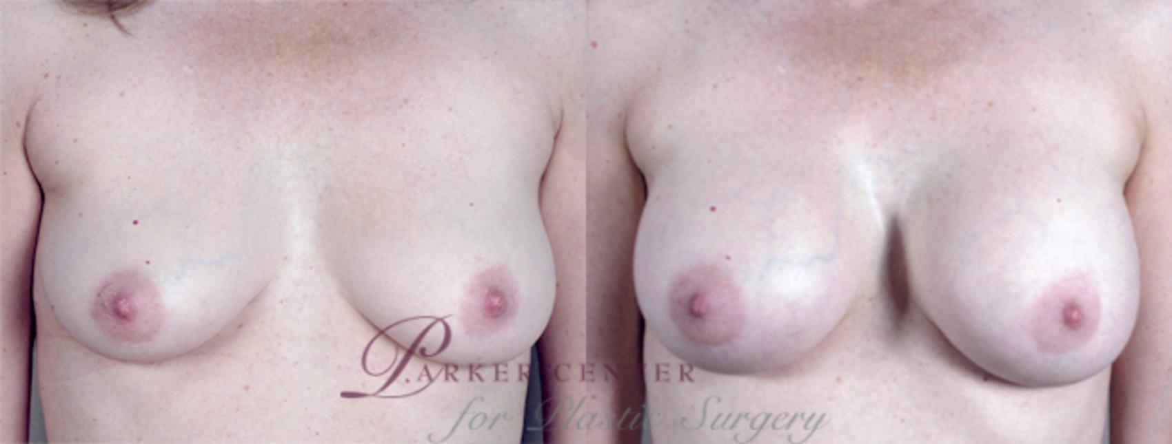 Liposuction Case 384 Before & After View #1 | Paramus, NJ | Parker Center for Plastic Surgery