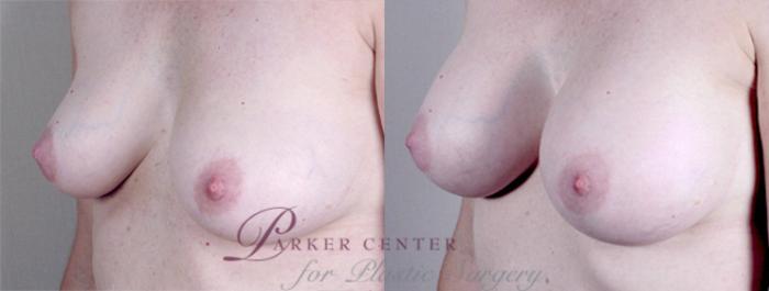 Liposuction Case 384 Before & After View #2 | Paramus, NJ | Parker Center for Plastic Surgery